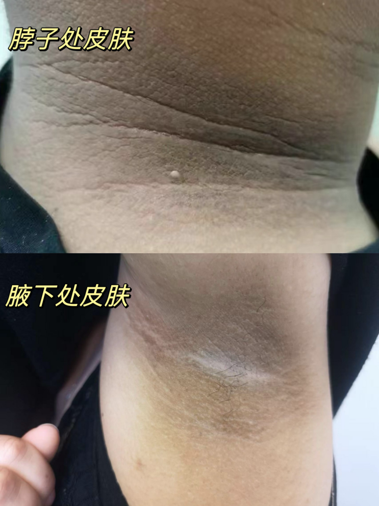 孩子皮肤黑你还单纯以为是晒太阳?出现这种情况要警惕「儿童肥胖」!