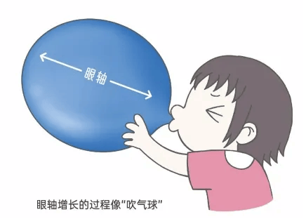 近视手术是否会损伤视网膜？湖北普瑞眼科医院为你解答