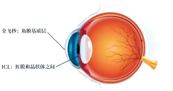 近视手术是否会损伤视网膜？湖北普瑞眼科医院为你解答