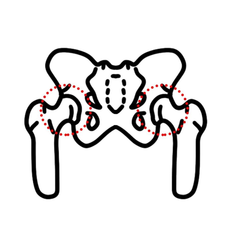 草莓骨科成功行全髋关节置换术，让患者「髋」心
