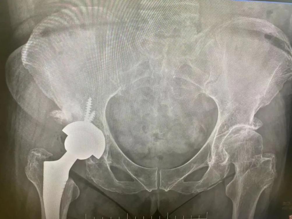 草莓骨科成功行全髋关节置换术，让患者「髋」心