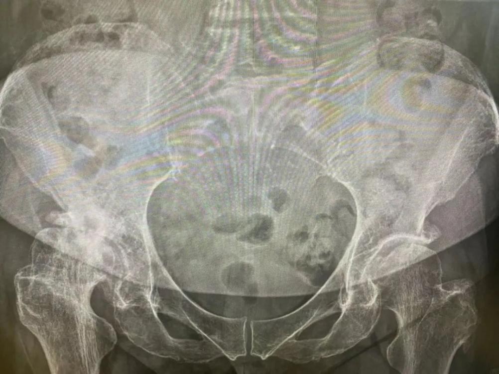 草莓骨科成功行全髋关节置换术，让患者「髋」心