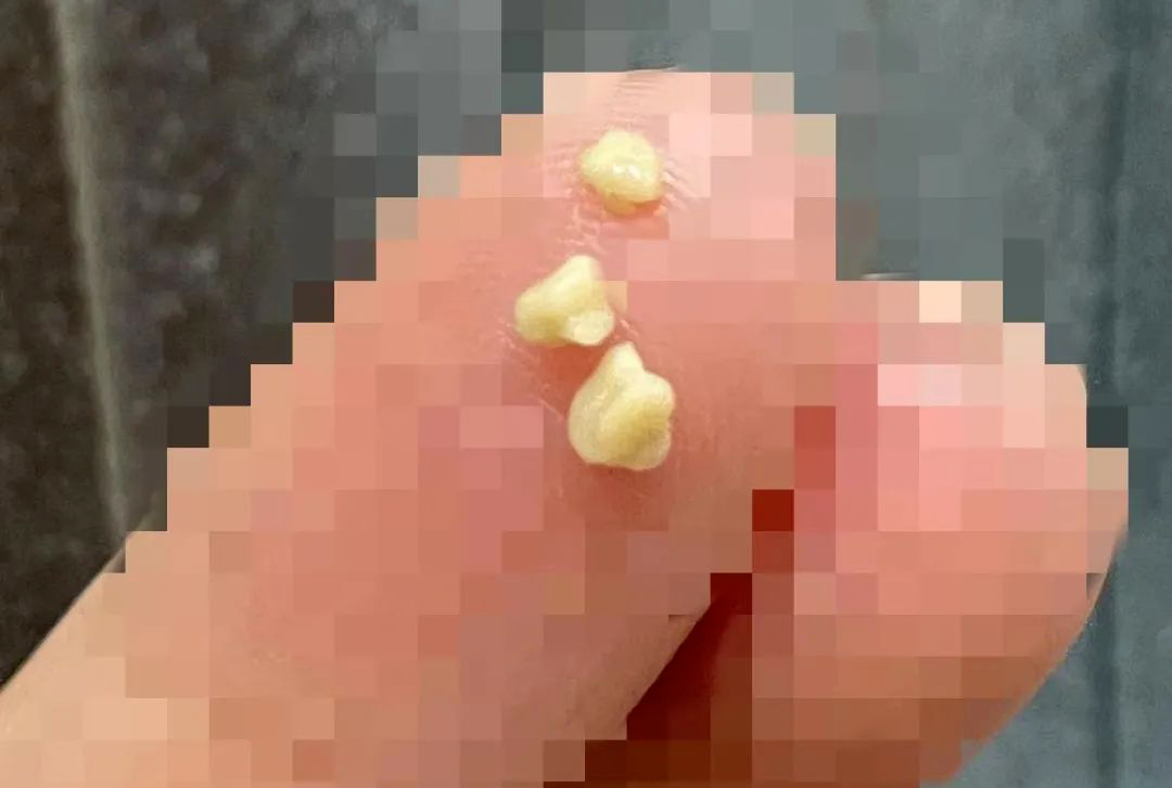 长了扁桃体结石，能自己挤掉吗？