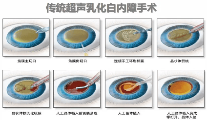 无惧时光·守护银龄|白内障手术有哪几种？