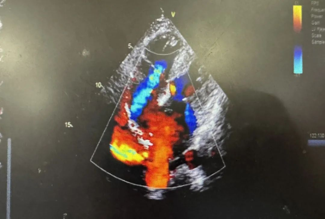 南昌大学二附院为罕见先心病患者完成一站式介入下行房缺及动脉导管未闭封堵术