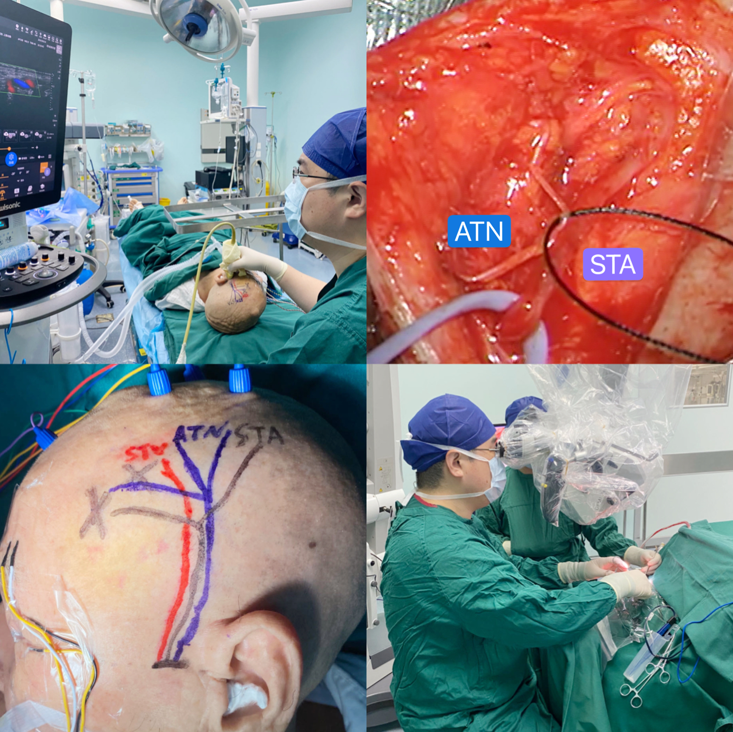 武汉大学人民医院开展显微神经血管减压术巧治顽固性偏头痛