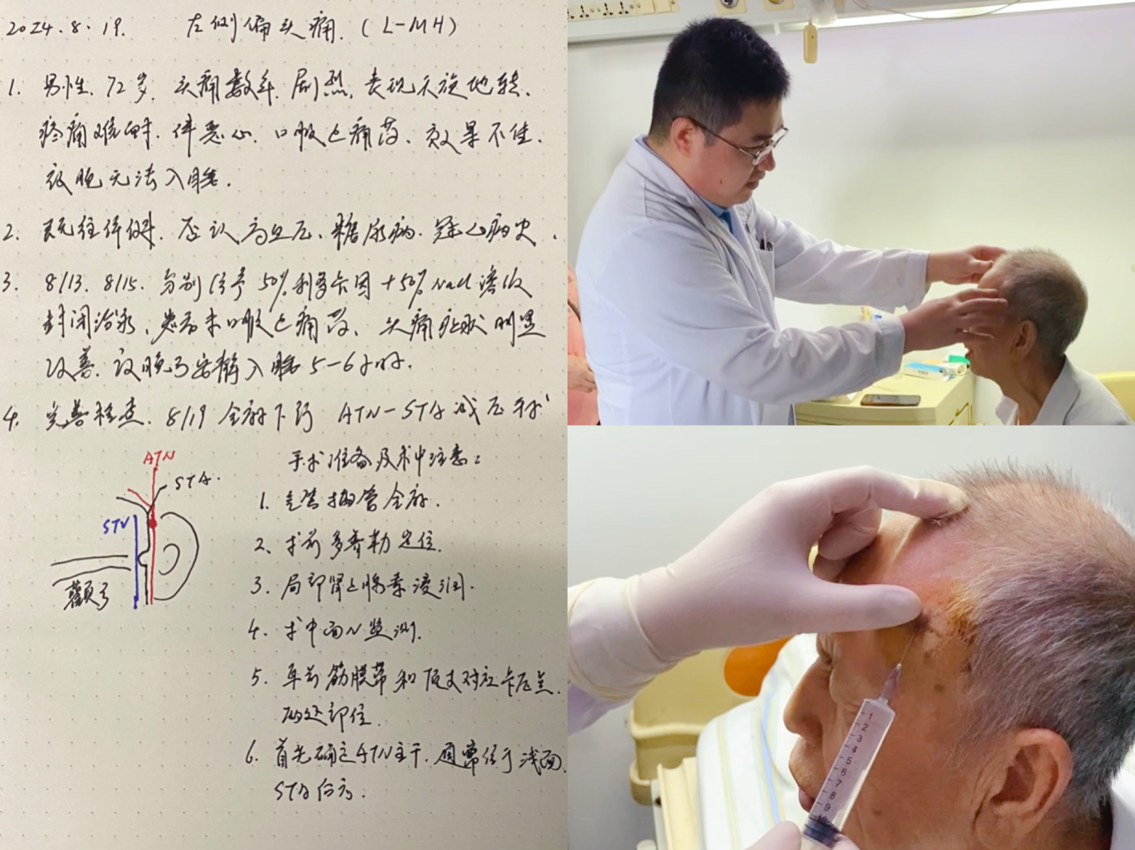 武汉大学人民医院开展显微神经血管减压术巧治顽固性偏头痛