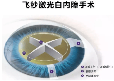 无惧时光·守护银龄|白内障手术有哪几种？