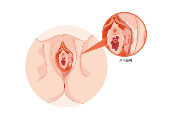 外阴白斑对女性有多不友好？