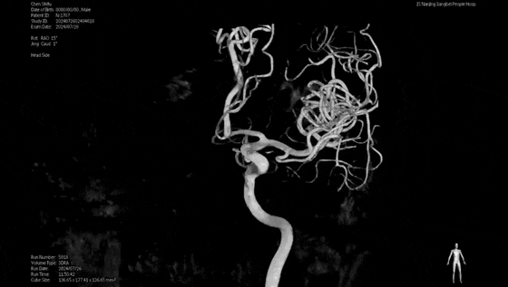 男子头晕查出脑动脉瘤，神外团队精细拆除「不定时炸弹」