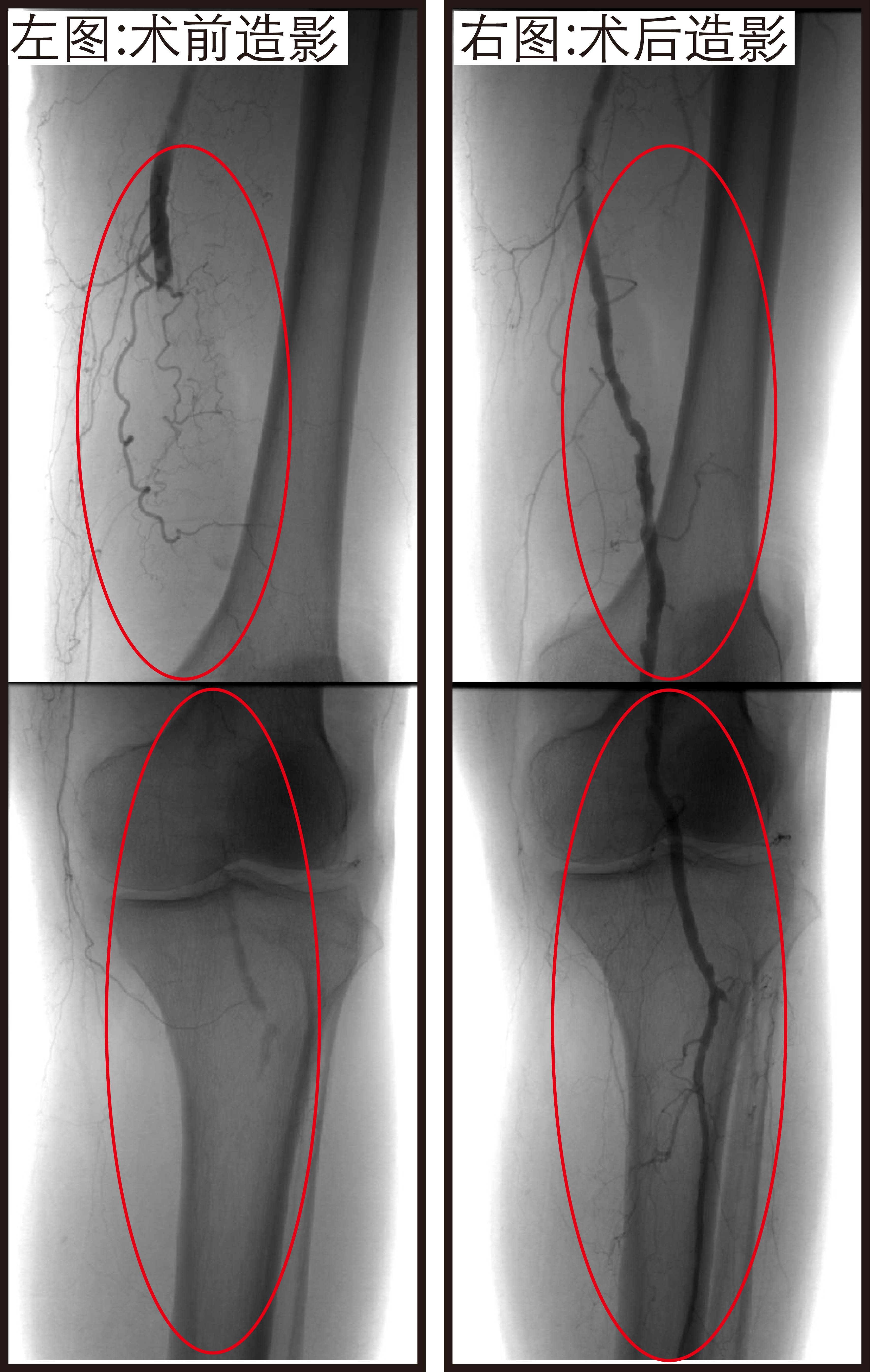 房颤未规范用药,百岁老人险截肢!武汉大学人民医院微创吸栓助他逃过一「截」