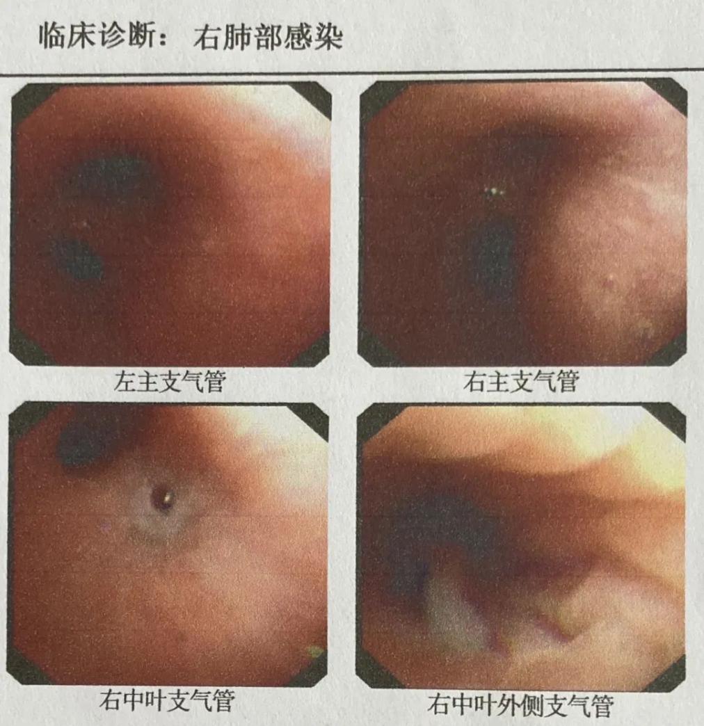 孩子咳嗽发烧老不好，因为这小生物，姐弟先后进医院！