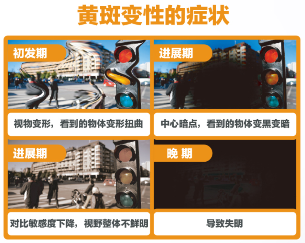 揭秘老年性黄斑变性:视力的隐匿窃贼