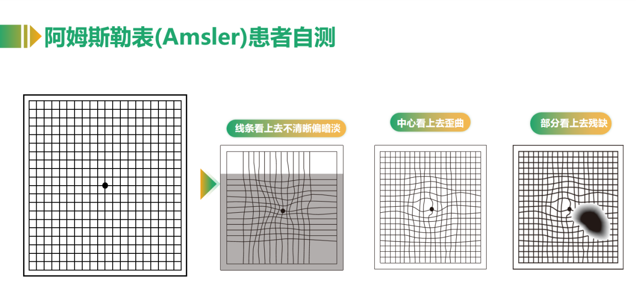 揭秘老年性黄斑变性:视力的隐匿窃贼