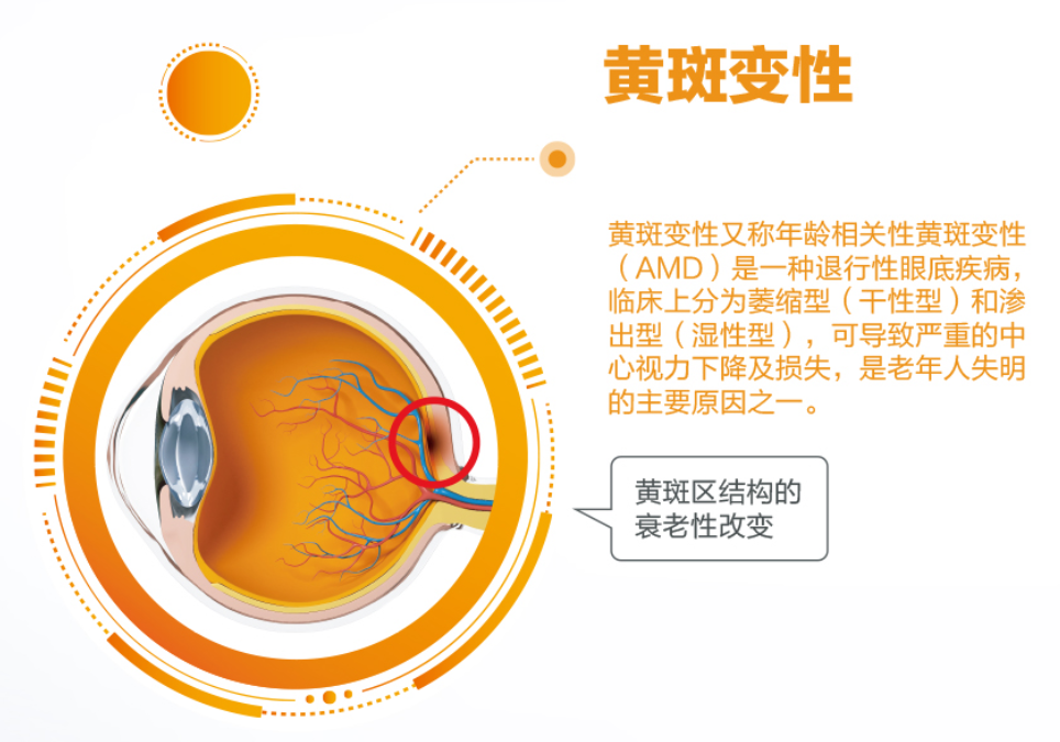 揭秘老年性黄斑变性:视力的隐匿窃贼