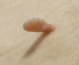 身上长的某些「小肉疙瘩」，居然跟 HPV 感染有关
