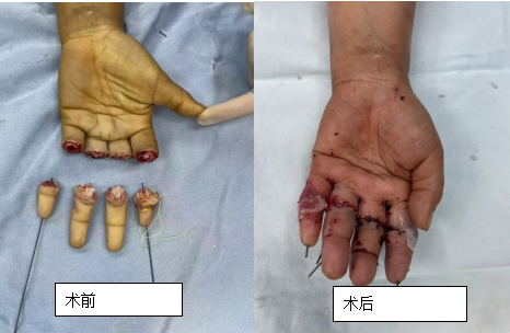 多手指离断再植术后护理体会