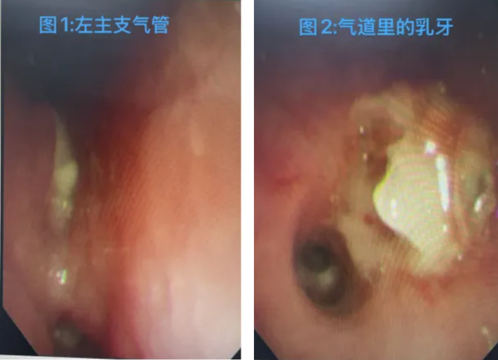 一觉醒来,乳牙居然掉进气管里!