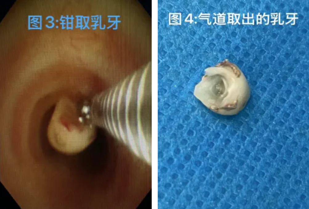 一觉醒来,乳牙居然掉进气管里!
