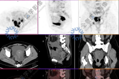 颈部的不明肿物，竟是转移癌？PET/CT 检查明确原发灶