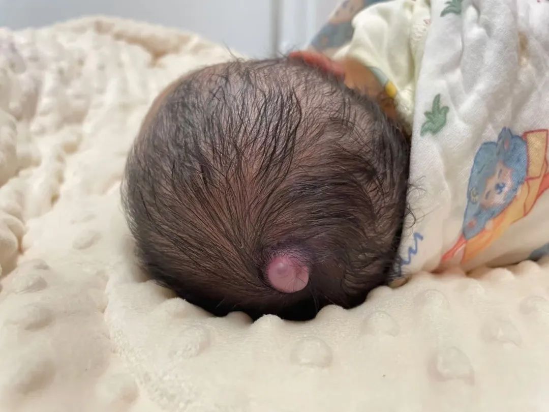 出生头顶「红宝石」,医生说:这个得摘掉