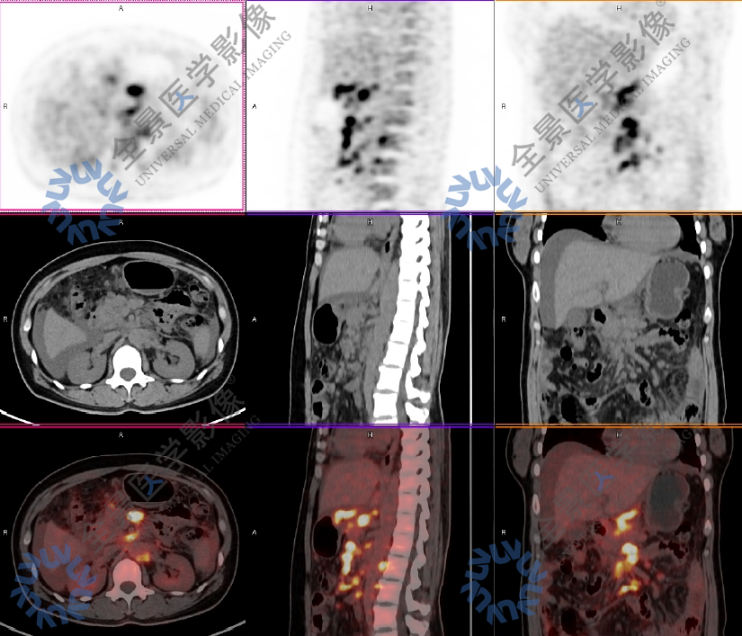 颈部的不明肿物，竟是转移癌？PET/CT 检查明确原发灶