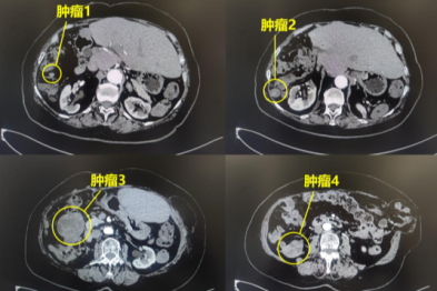 7 旬老人与肿瘤斗争 30 年，微创手术切除多发病灶！