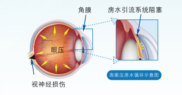 焦虑也会导致青光眼？武汉普瑞眼科专家提醒情绪也会影响眼健康