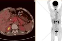 【高尚病例】隐匿性胰腺癌的 PET/CT 诊断