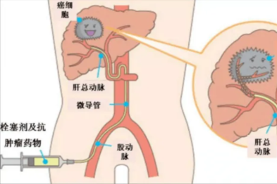 癌症「警报降级」，他们成功为老人赢得生机！