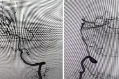 南昌大学二附院携手上饶市中心医院成功救治进展型脑卒中患者