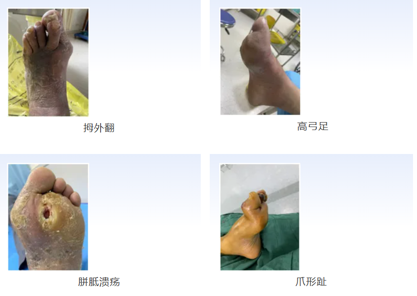 打响肢体保卫战——警惕糖尿病周围神经病变