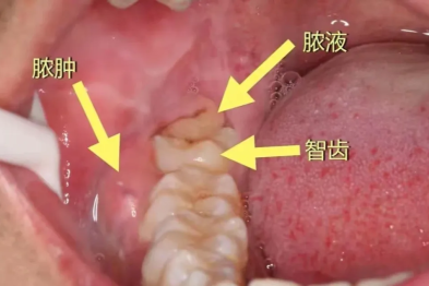 智齿疼起来可让人原地爆炸？智齿冠周炎不容忽略！