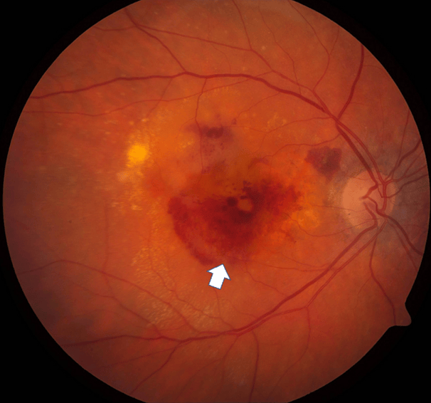 湖北普瑞眼科医院|什么是老年性黄斑变性?怎么预防?