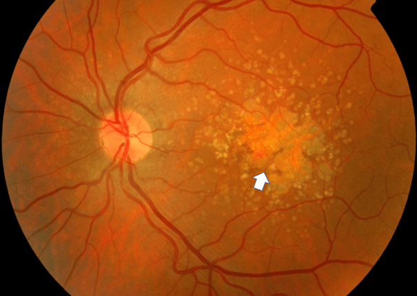 湖北普瑞眼科医院|什么是老年性黄斑变性?怎么预防?