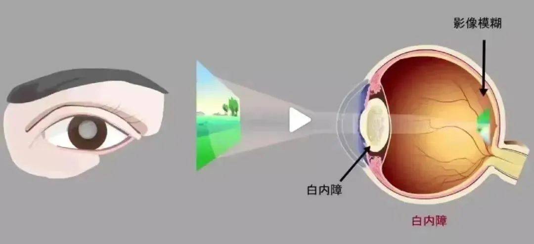 眼睛受到外伤会得白内障吗？湖北普瑞眼科医院彭华琮院长解答