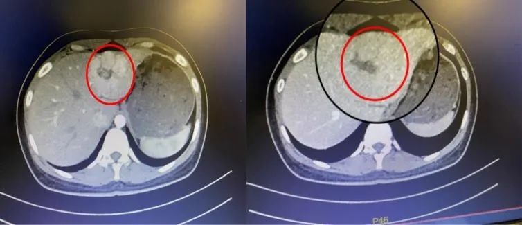 微创再升级！一孔之力守护漳州 23 岁花季少女的青春之梦