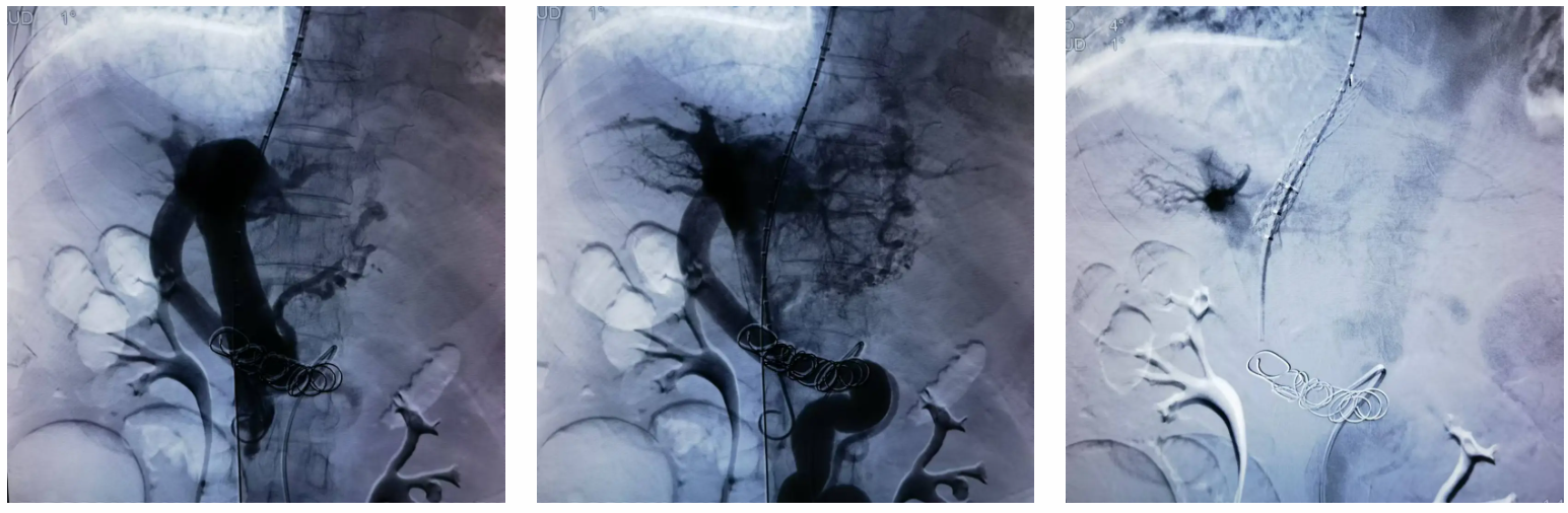 岳池县人民医院成功开展 TIPS 经颈静脉肝内门腔静脉内支架分流术