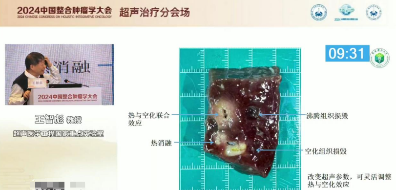 王智彪教授在 2024 中国整合肿瘤学大会畅谈高强度聚焦超声一个颠覆性的前沿性技术