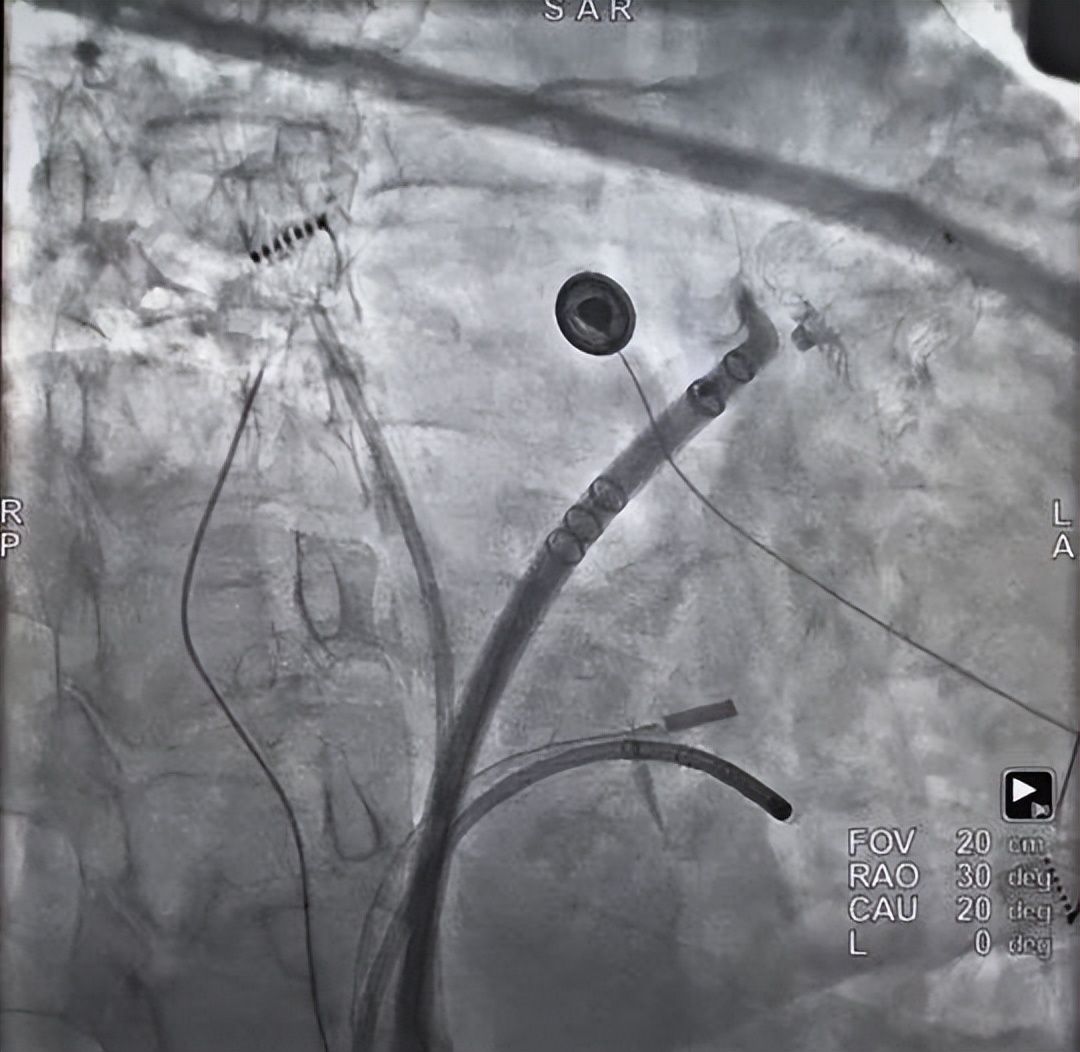 西安交大二附院完成西北地区首例一站式 FARAPULSE 脉冲导管消融联合 Watchman FLX 左心耳封堵术