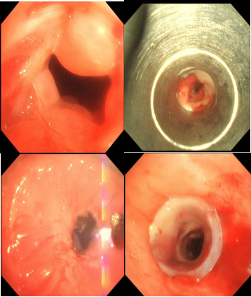 南昌大学二附院成功完成经硬镜气管支架置入术
