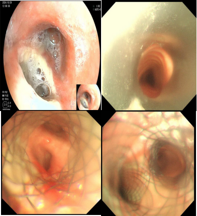 南昌大学二附院成功完成经硬镜气管支架置入术