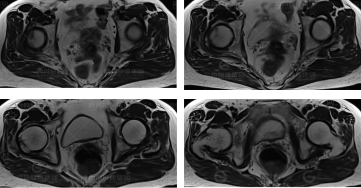 【高尚病例】髋关节撞击综合征的 MRI 表现
