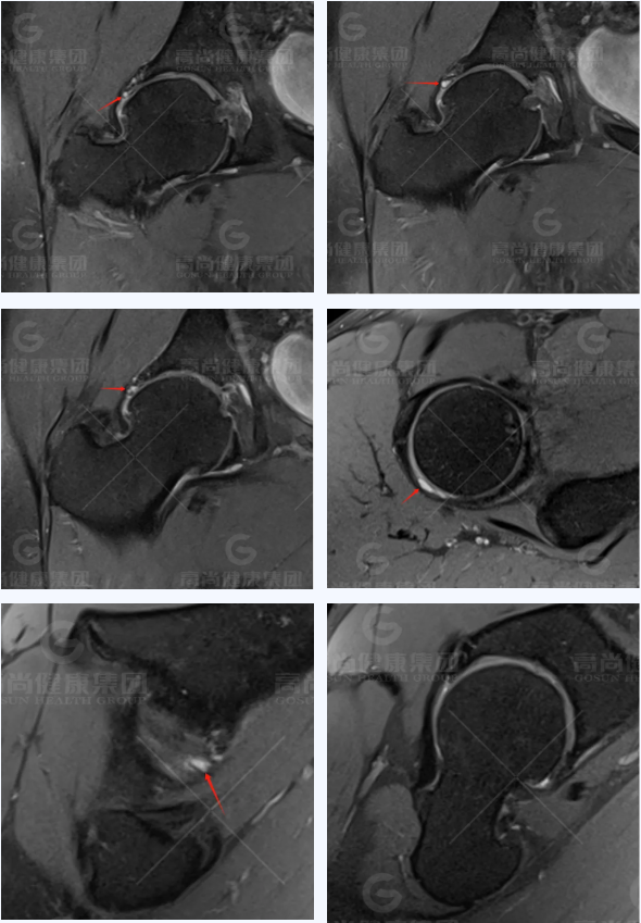 股骨头坏死mri表现图片