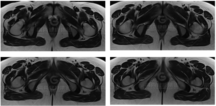 【高尚病例】髋关节撞击综合征的 MRI 表现