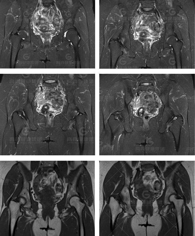 【高尚病例】髋关节撞击综合征的 MRI 表现