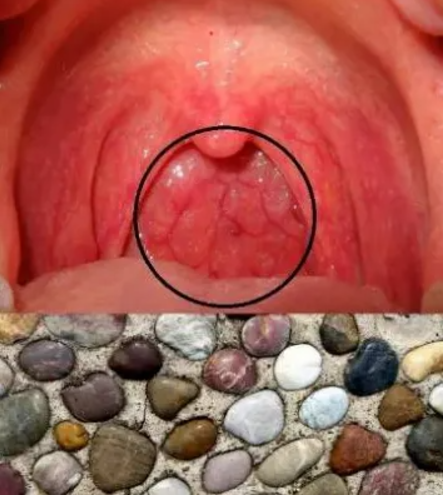 【健康科普】孩子咳嗽老不好？难道是「慢性咳嗽」？