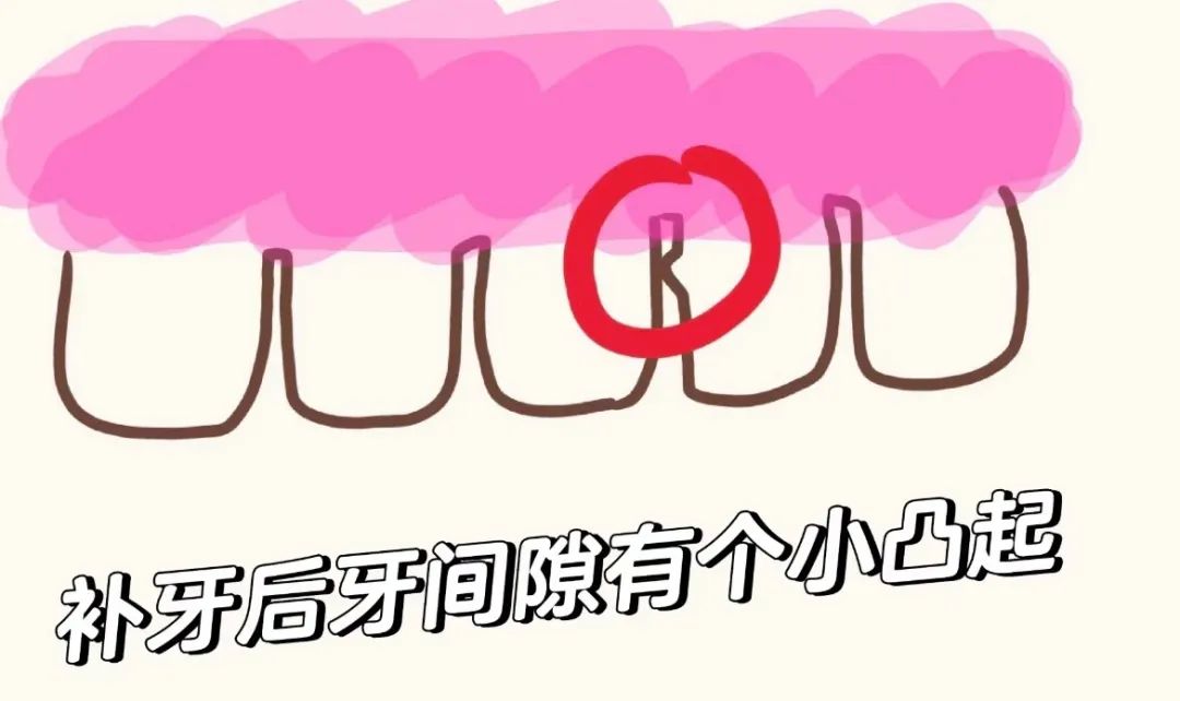 牙龈乳头，怎么会发炎了呢？