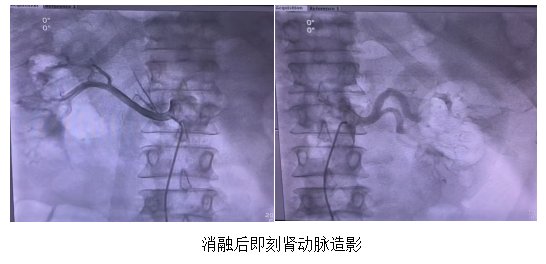 全国首批、江西首例！南昌大学二附院应用 msRDN 介入治疗难治性高血压