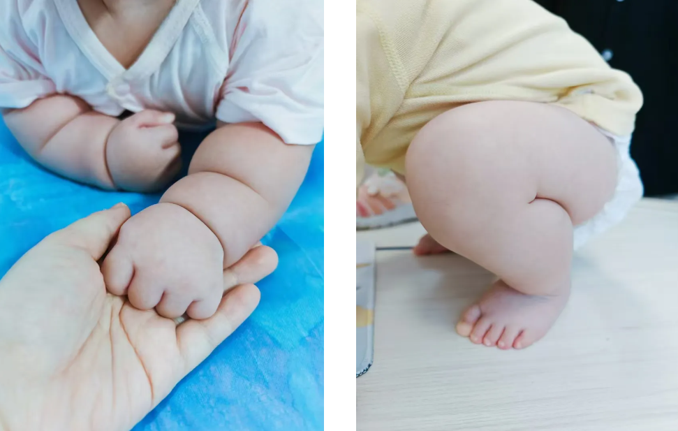 臀纹不对称，提示髋关节发育不良？